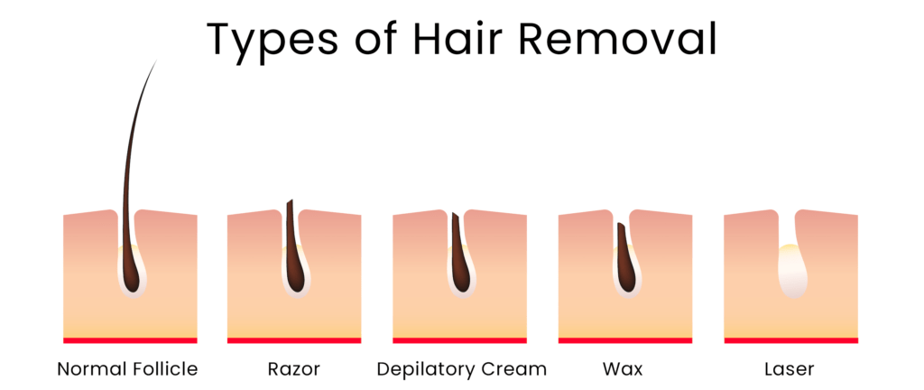 most effective hair removal