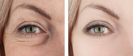 Baggy Eyes